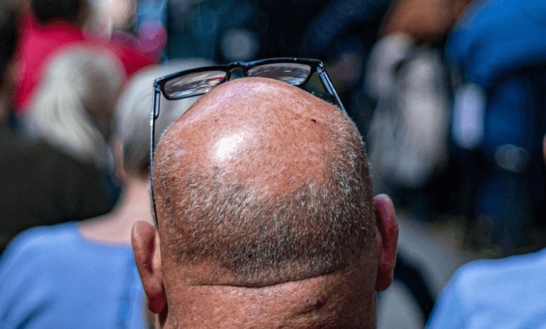 Hombre calvo decidió tatuarse pelo en su cabeza 