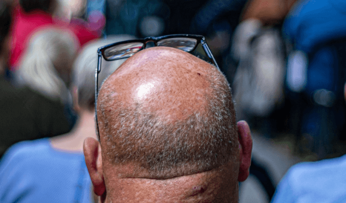 Hombre calvo decidió tatuarse pelo en su cabeza 